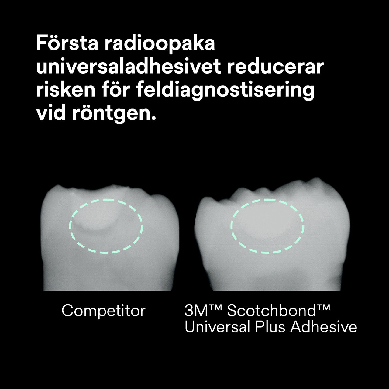 (2) Scotchbond™ Universal Adhesive Plus: Det första radiopaka universalhäftämnet