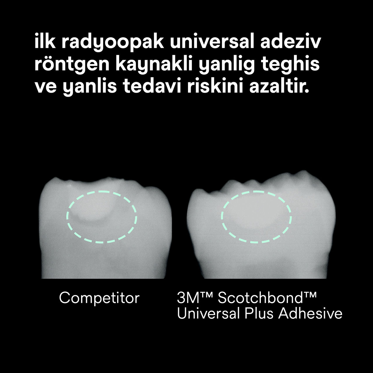 (2) Scotchbond Universal Plus Yapıştırıcı: İlk radyopak evrensel yapıştırıcı, röntgen riskini azaltır