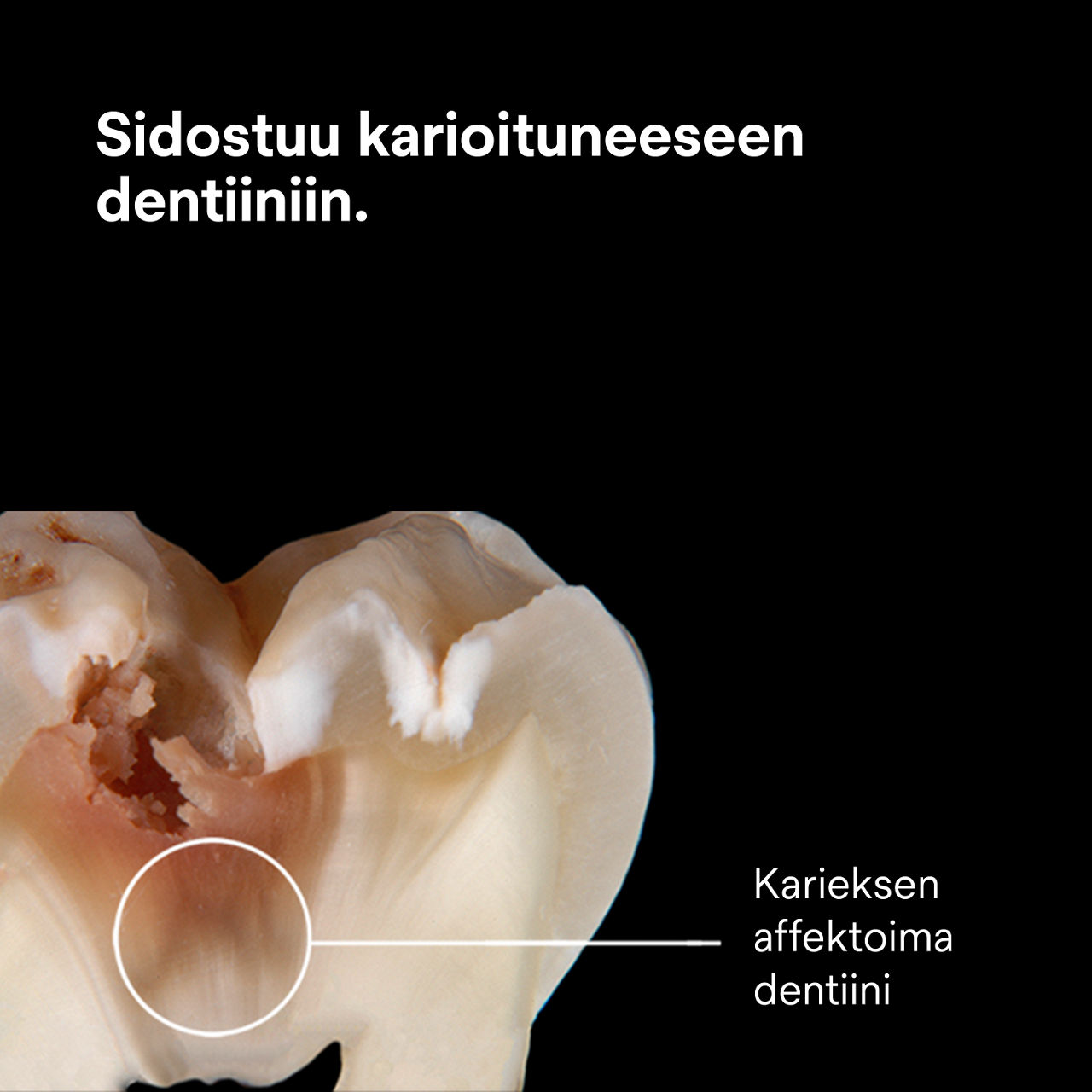 (3) Scotchbond Universal Plus Adhesive: Kiinnittyy ja sulkee karieksen vaurioittaman dentiinin