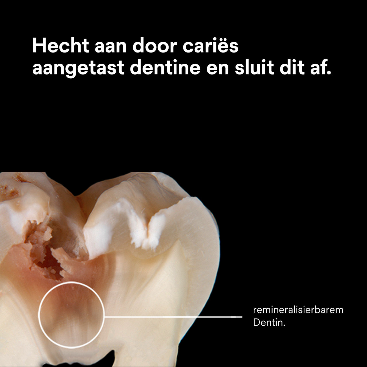 (3) Scotchbond Universal Plus Adhesief: Hecht en verzegelt door cariës aangetaste dentine.