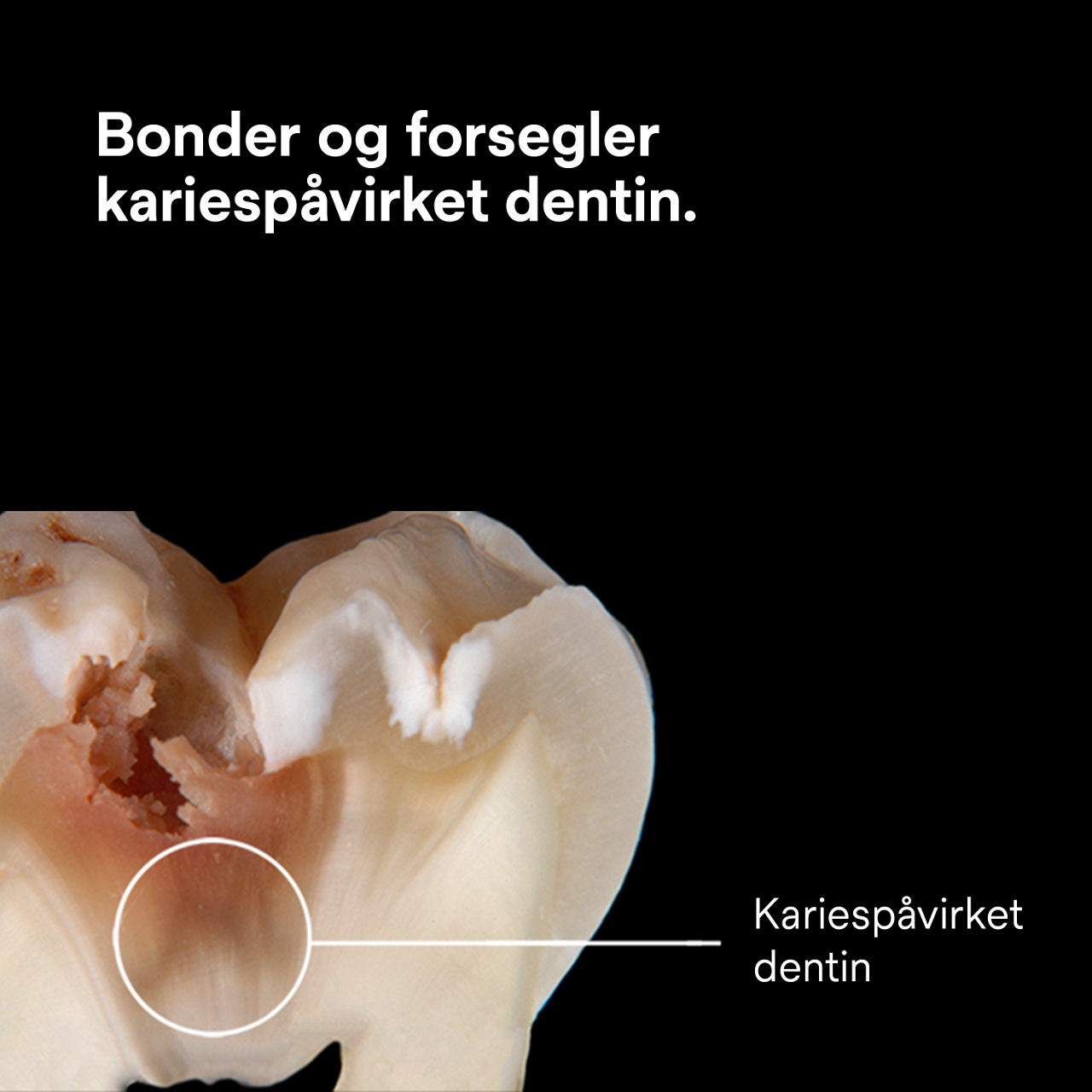 (3) ScotchBond™ Universal Adhesive Plus: Adhesjon og forsegling av kariesaffisert dentin