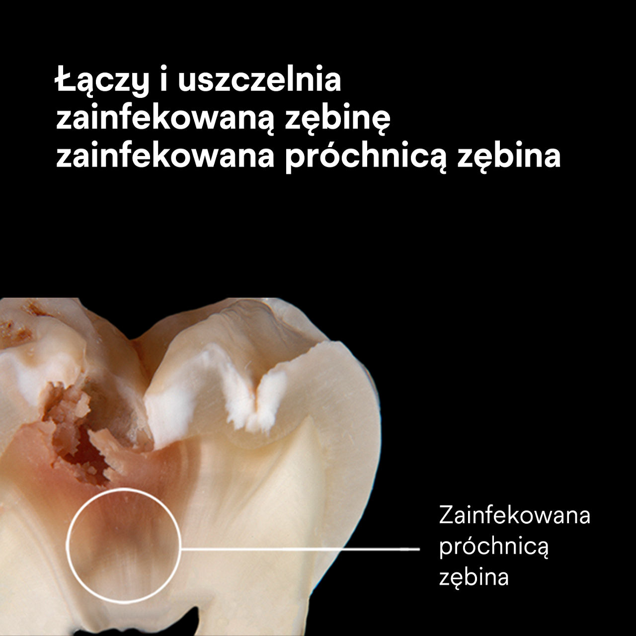(3) ScotchBond™ Universal Adhesive Plus: Adhezja i uszczelnianie zębiny dotkniętej próchnicą