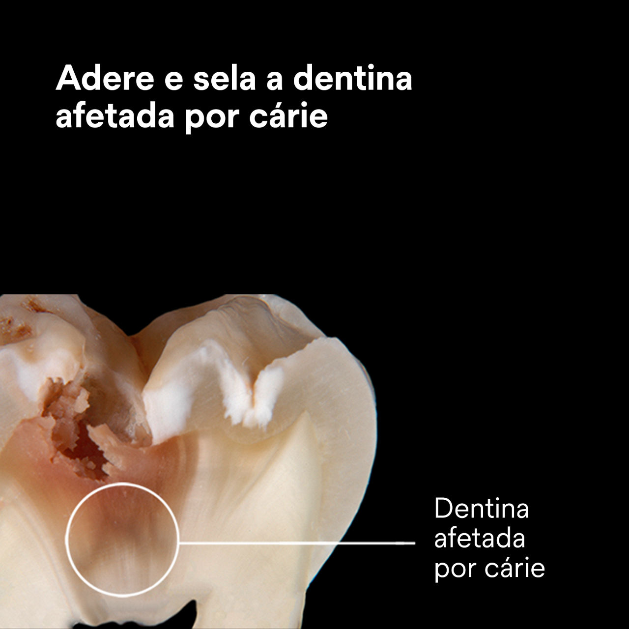 (3) Scotchbond Adesivo Universal Plus: Adere e sela dentina afetada por cárie