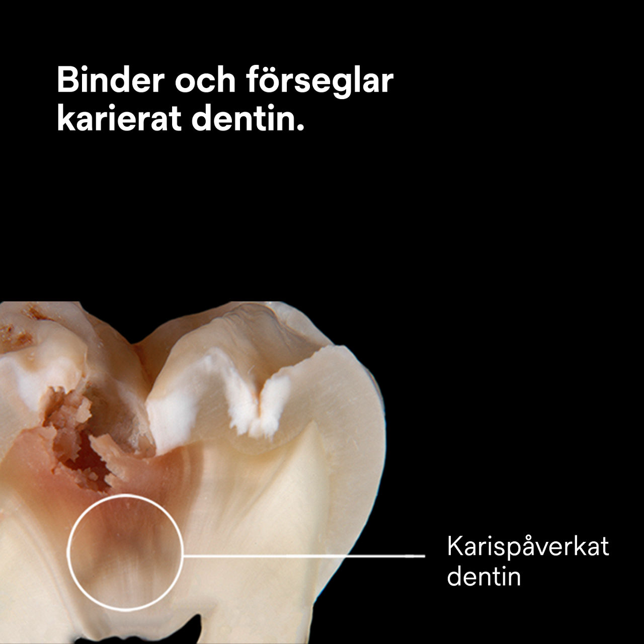 (3) ScotchBond™ Universal Adhesive Plus: Vidhäftning och försegling av kariesdrabbat dentin