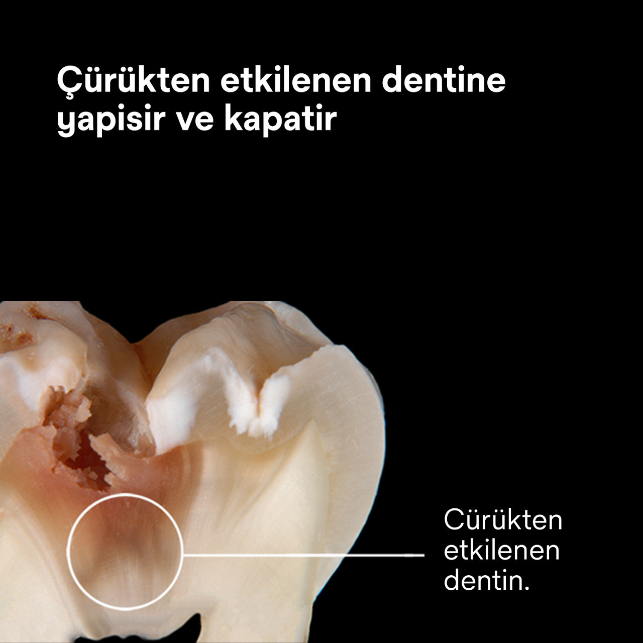 (3) Scotchbond Universal Plus Yapıştırıcı: Çürükten etkilenen dentini bağlar ve mühürler