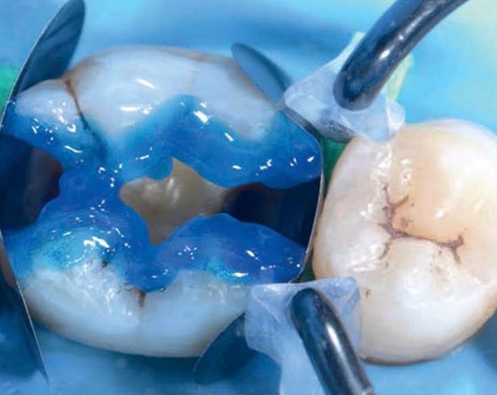 Selective etching of enamel