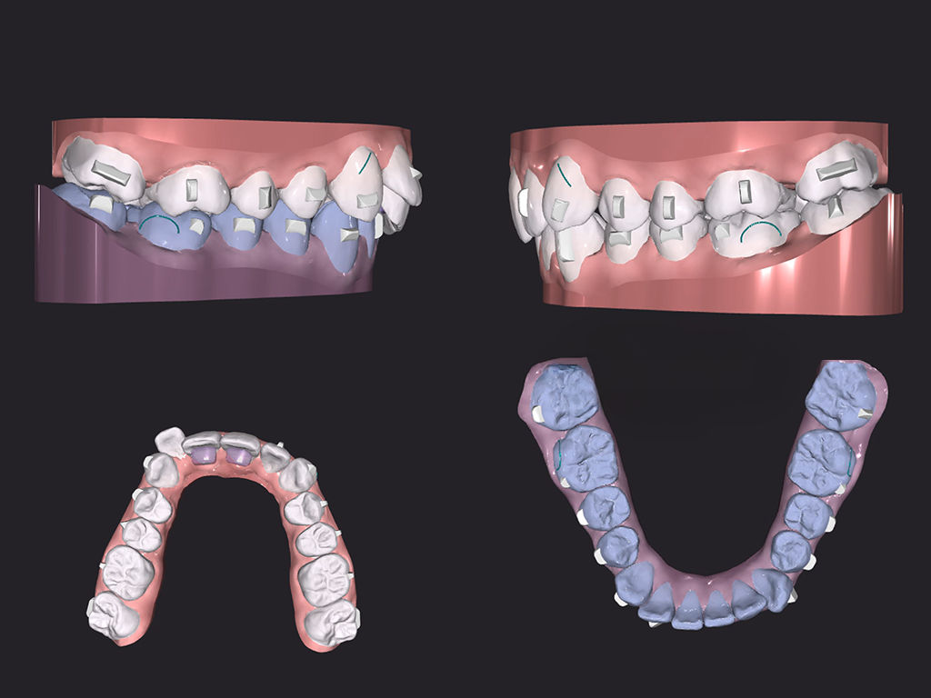 Treatment design
