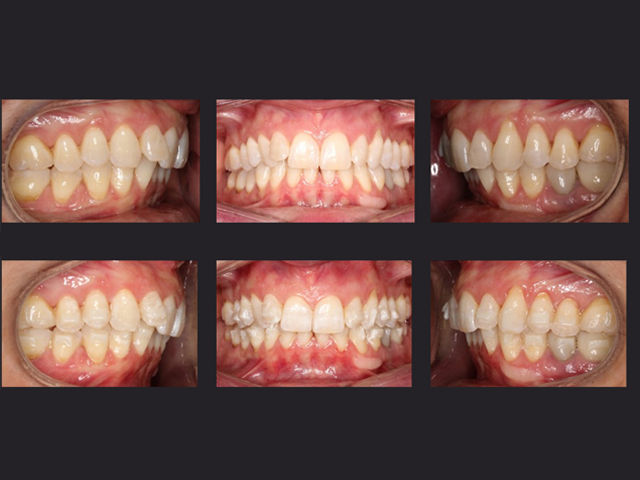 Initial situation for aligners case
