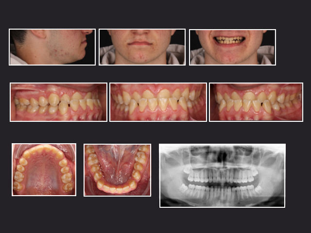 Initial situation for digitally bonded bracket case