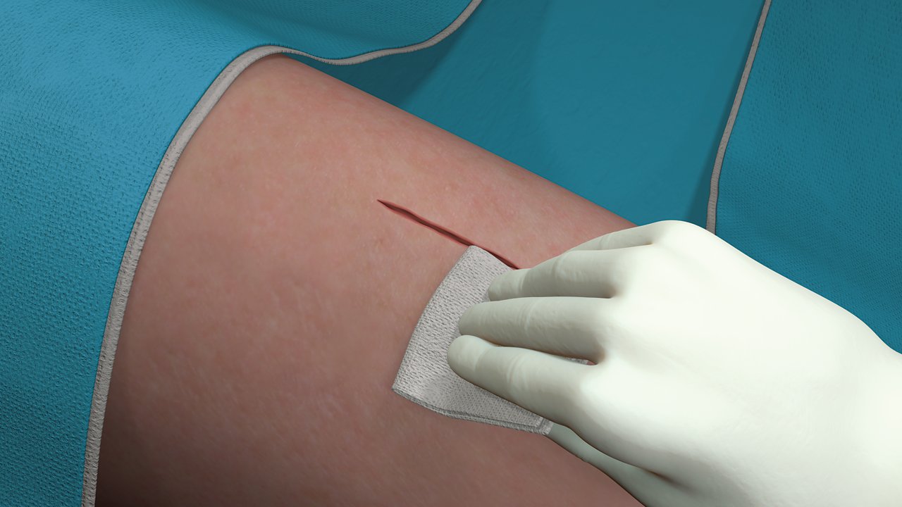 Step 1 for the application of Steri-Strip Adhesive Closures