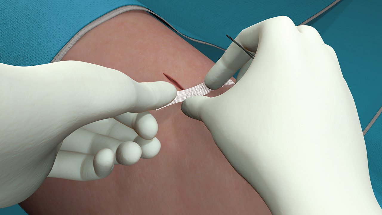 Step 5 for the application of Steri-Strip Adhesive Closures