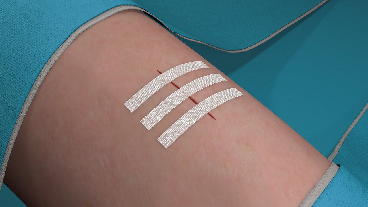 Stap 6 voor het aanbrengen van Steri-Strip Hechtstrips