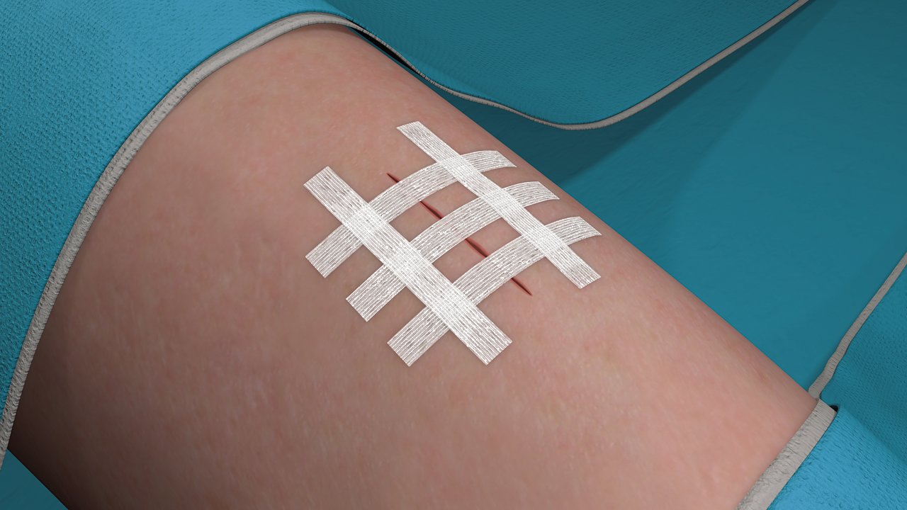 Stap 7 voor het aanbrengen van Steri-Strip Hechtstrips