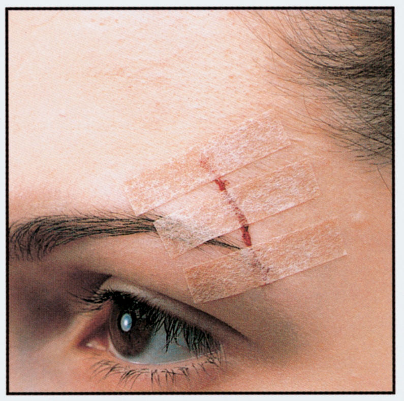 steri_strip_skin_tone