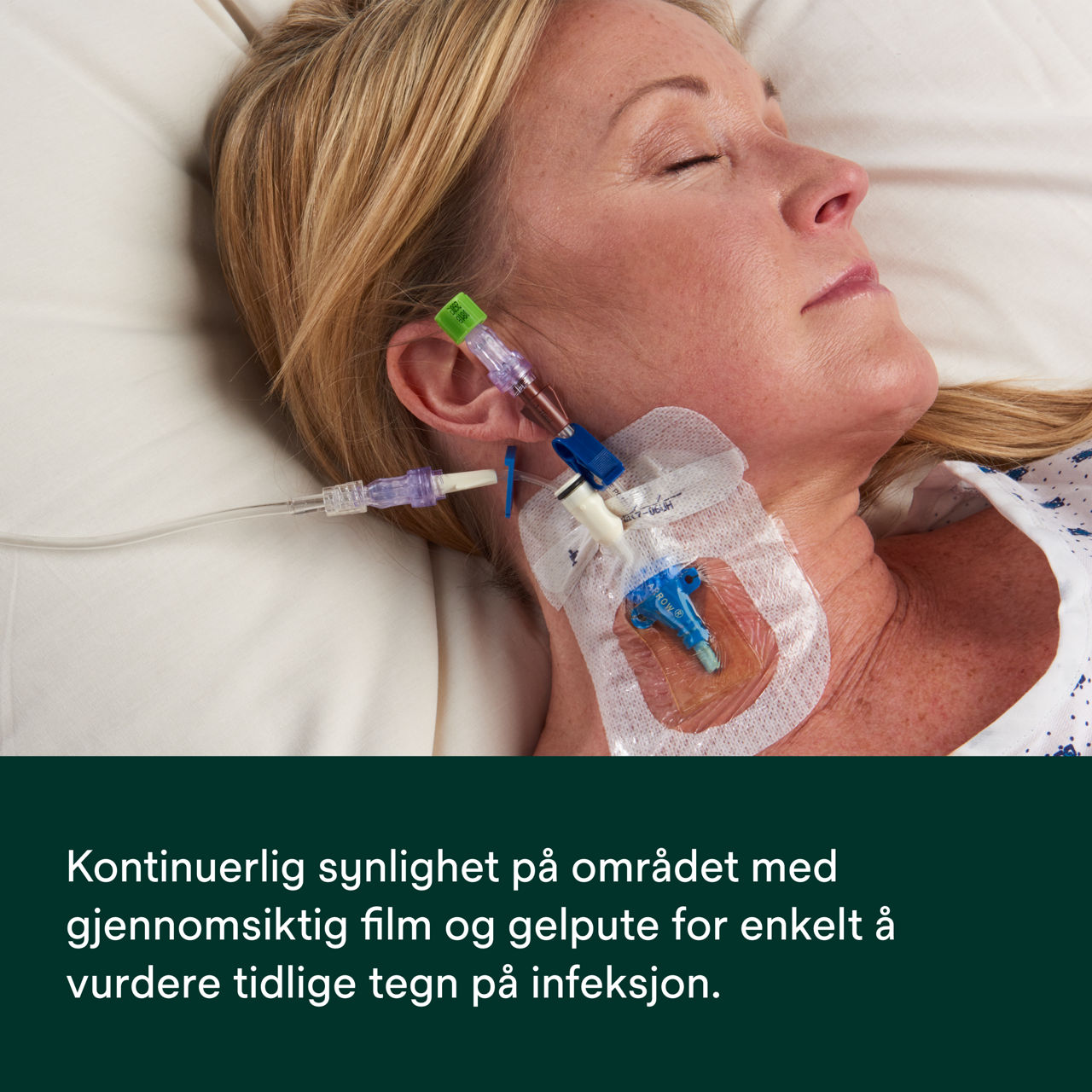 (5) Tegaderm CHG IV Securement 1657: Kontinuerlig synlighet på stedet