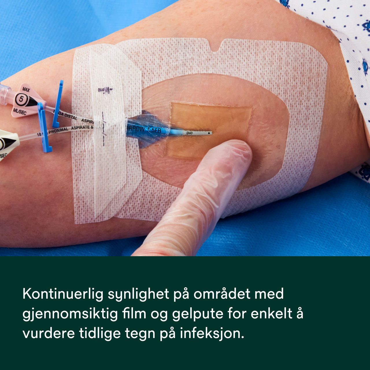 (5) Tegaderm CHG IV Securement 1658: Kontinuerlig synlighet på stedet