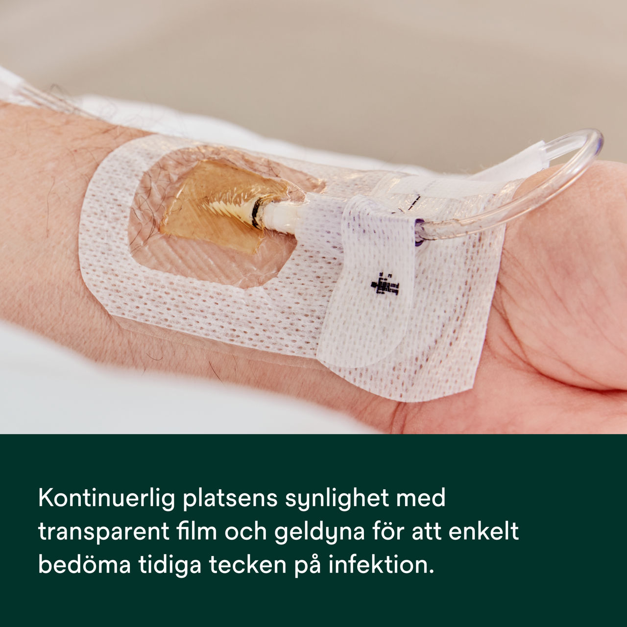 (5) Tegaderm CHG IV Securement 1660: Kontinuerlig synlighet på platsen