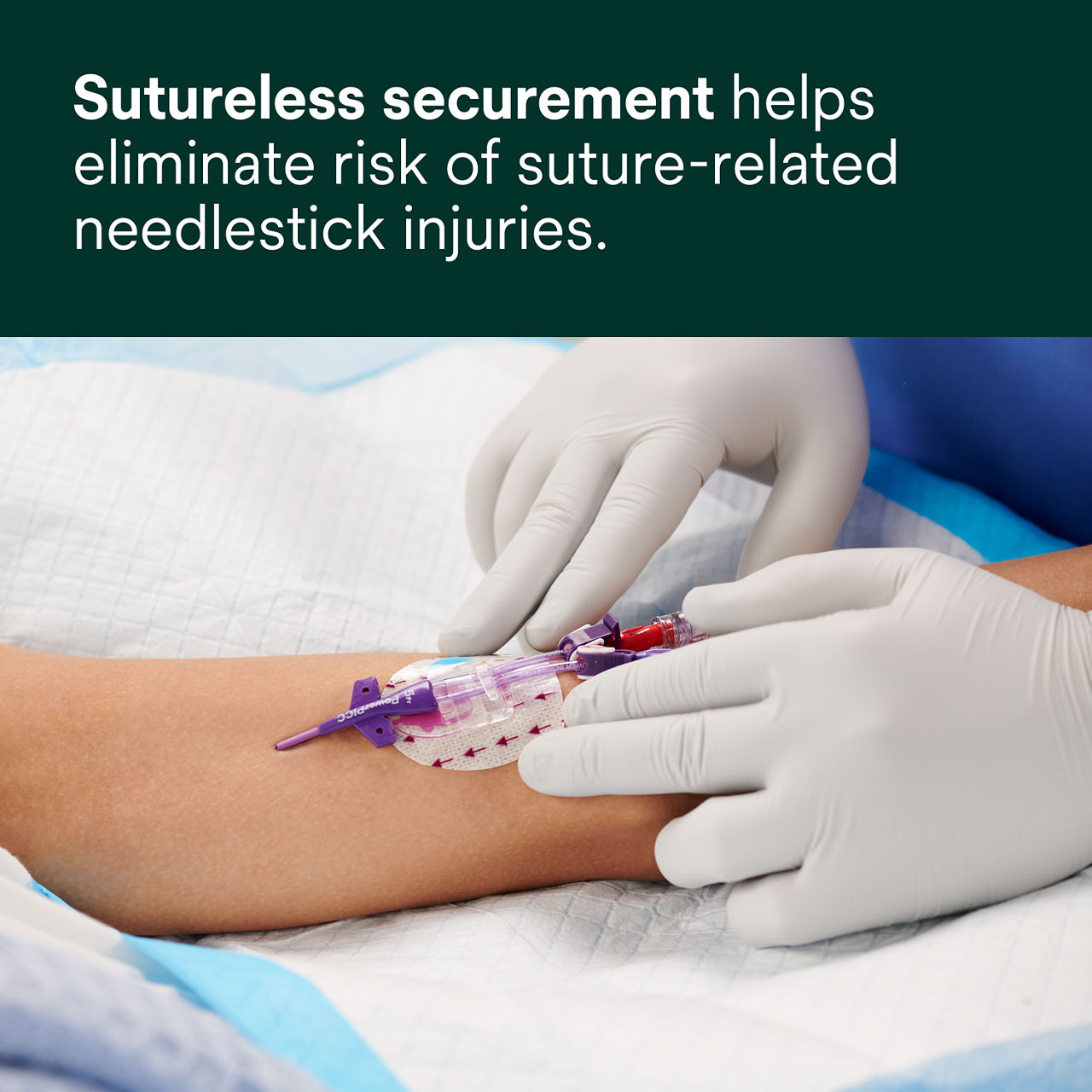 (2) 3M PICC/CVC + Tegaderm IV Advanced Securement: Sutureless securement