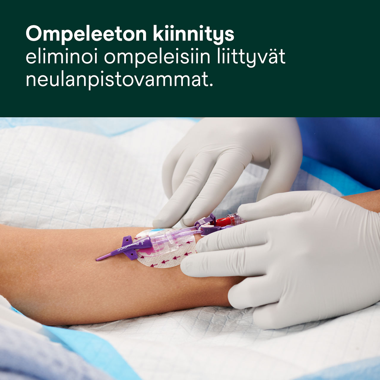 (2) 3M PICC/CVC + Tegaderm IV Advanced Securement: Ompeleeton kiinnitys