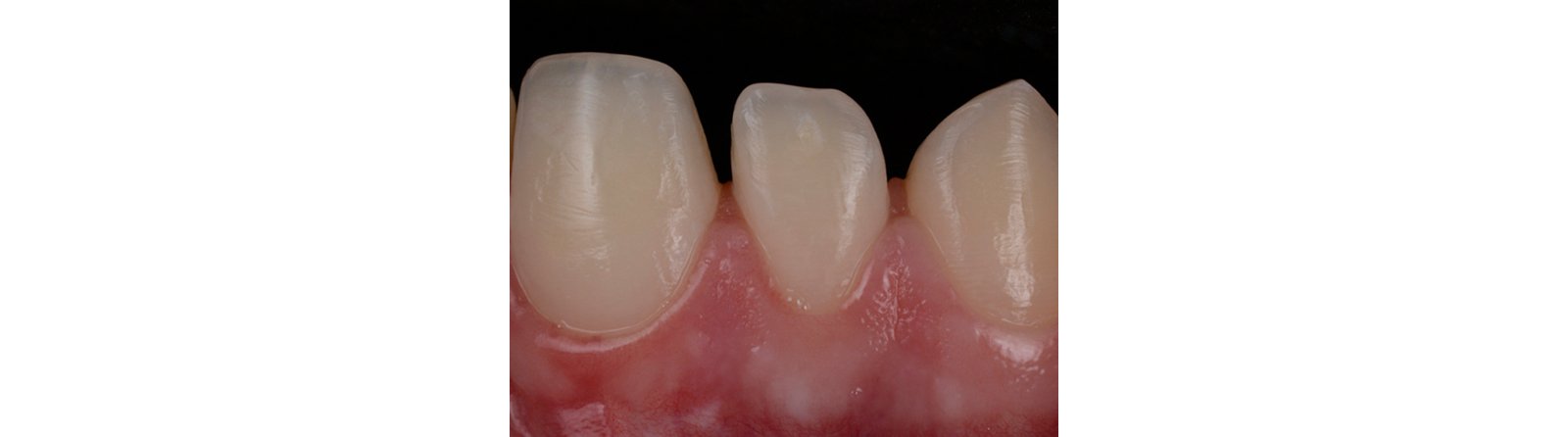 Patient is ready for restorative treatment