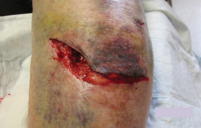 Bild der unteren Extremität, traumatische Wunden, Fallstudie, Fotos mit freundlicher Genehmigung von Christopher L. Barrett, DPM, CWS, FACCWS; Crozer Chester Medical Center, Chester, PA, Klinisches Bild