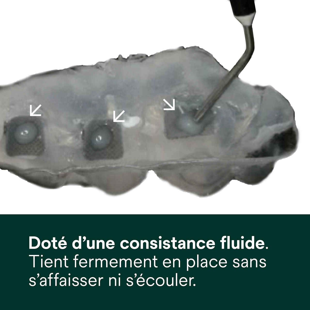 (2) Adhésif Transbond Supreme LV Fluide. Reste en place sans affaissement ni débordement