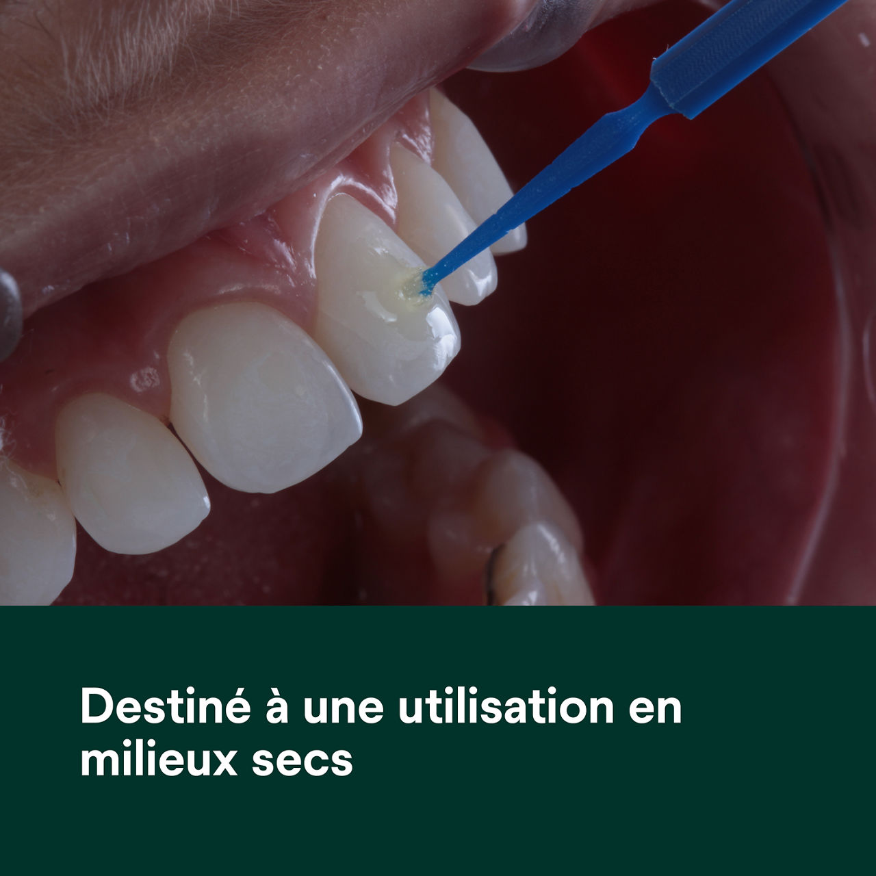 (2) Primer adhésif Transbond XT à polymérisation pour utilisation dans des environnements secs