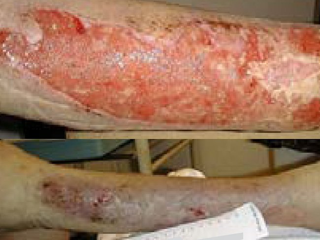 Wound management of a trauma injury measuring over 20 cm in length to the lateral right leg after a fall. Image shows the wound before and after the treatment with 3M™ Kerramax Care™ Super-Absorbent Dressing and the 3M™ Coban™ 2 Two-Layer-Compression System.