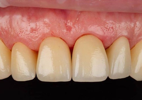 Try-in of final zirconia restorations