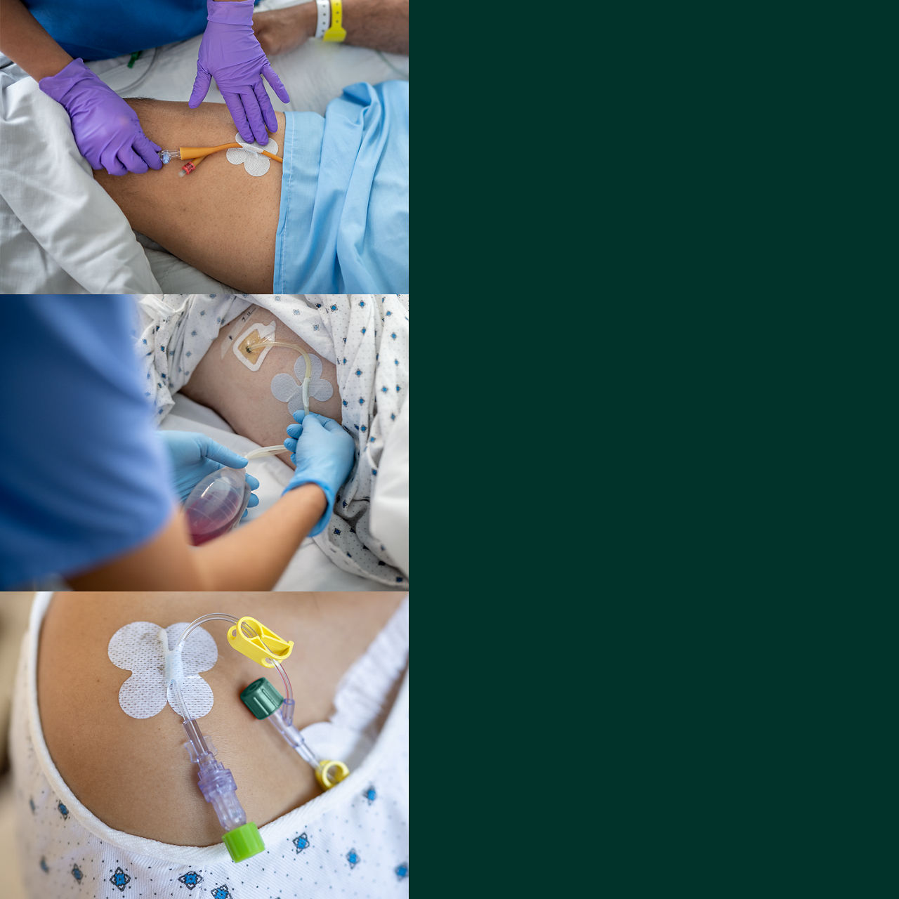 (3) Tüp Sabitleme Cihazı: İdrar kateterleri, cerrahi dren tüpleri, IV'ler için ek sabitleme