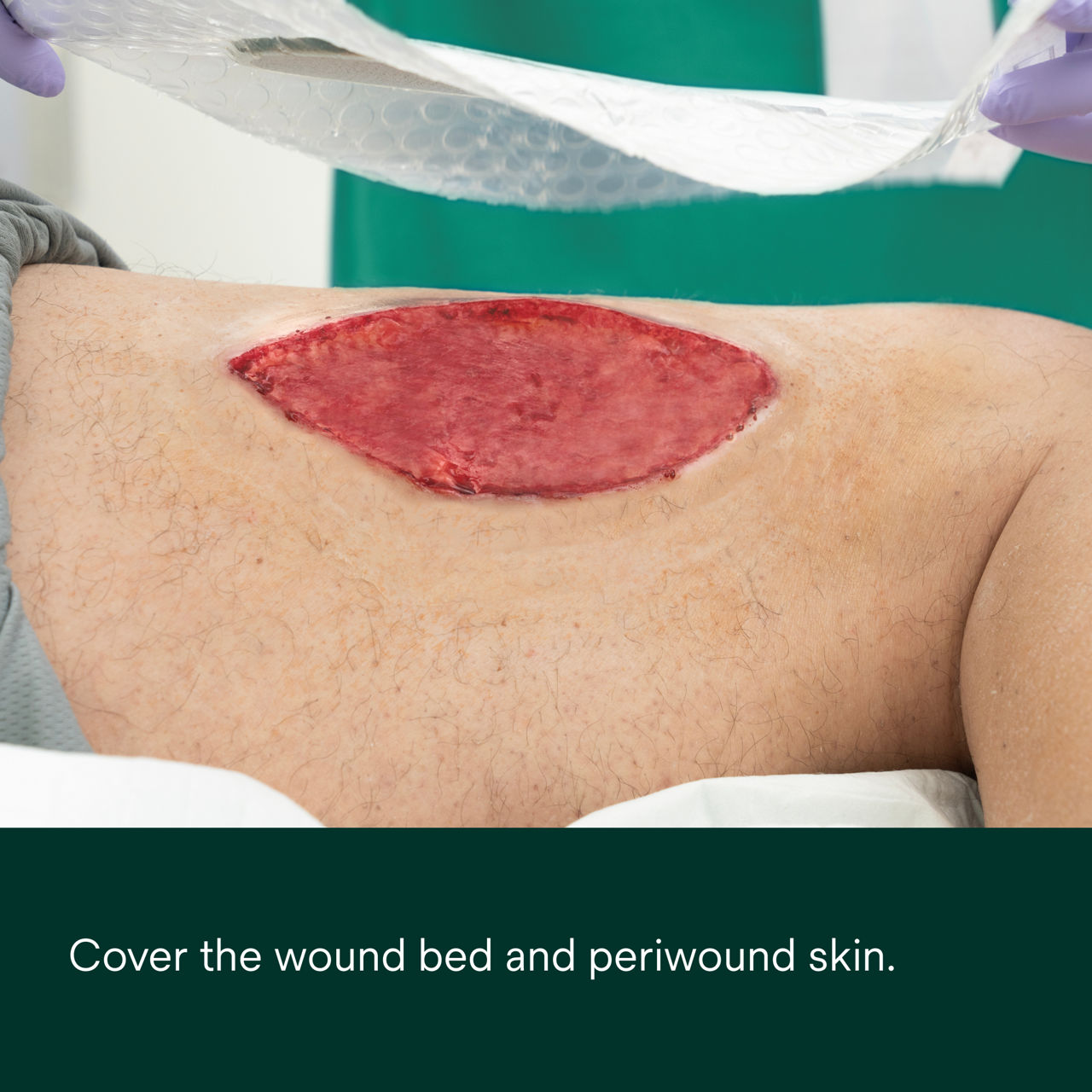 1: V.A.C. Peel and Place - Cover the wound bed and periwound skin