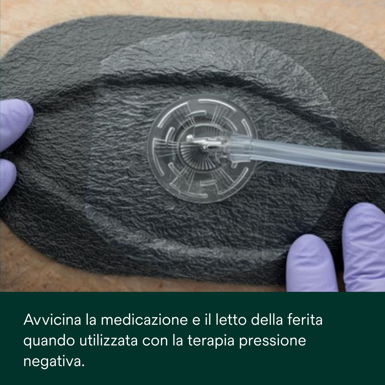 1: V.A.C. Peel and Place - Coprire il letto della ferita e la cute perilesionale.