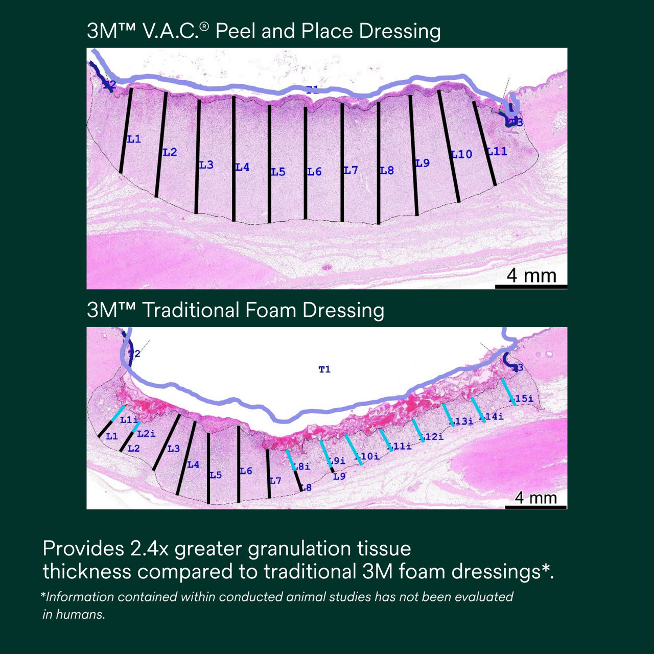 6: V.A.C. Peel and Place - Provides 2.4 greater granulation tissue thickness