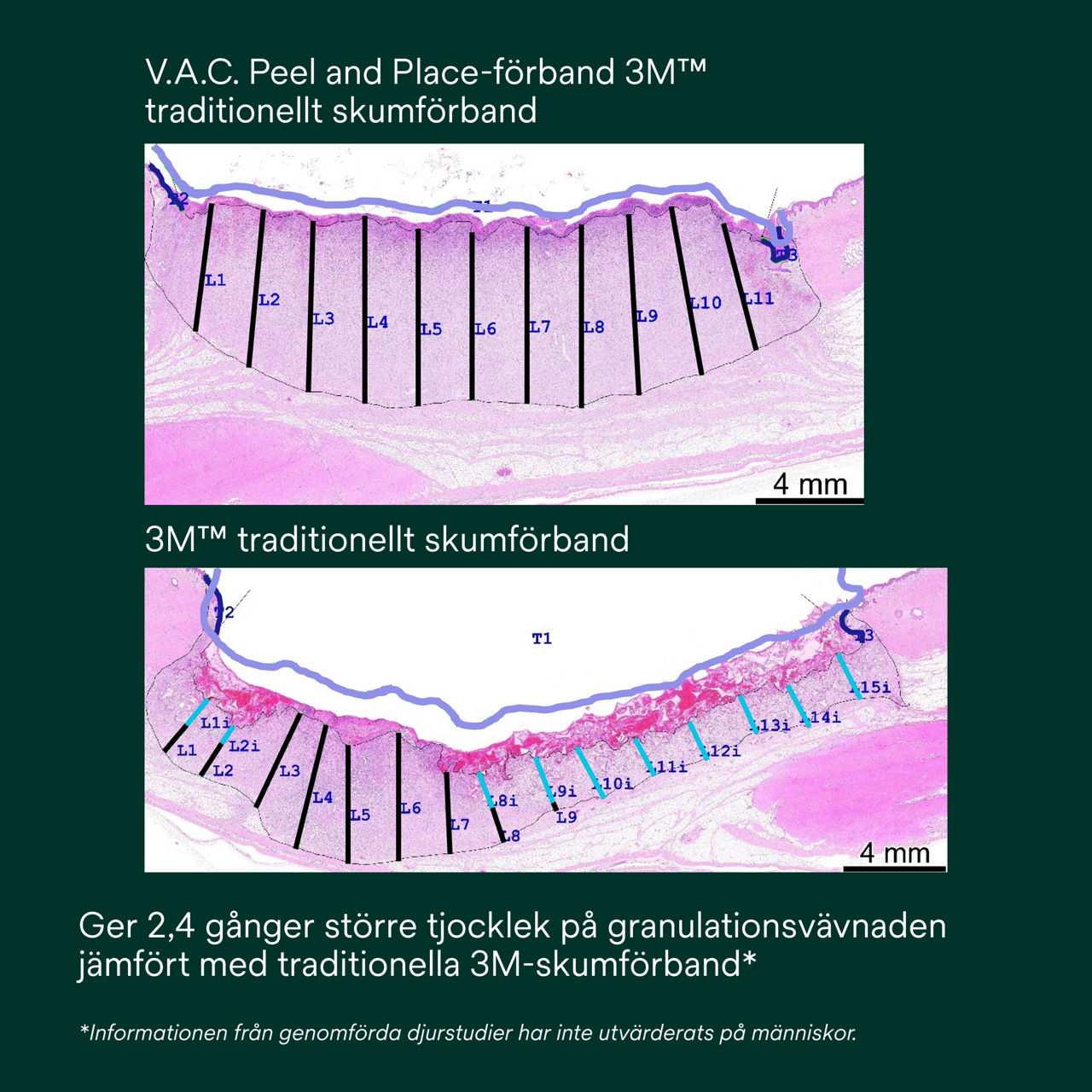 6: V.A.C. Peel and Place – Ger 2,4 gånger större granulationsvävnadstjocklek