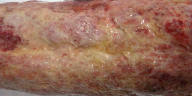 Wounds with thick exudate, slough, infectious material and other wound debris
