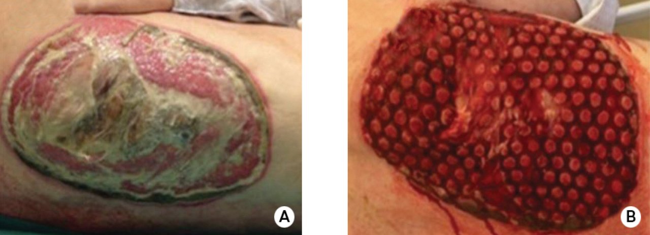 V.A.C. Veraflo Therapy, debridement, before and after treatment, Clinical image