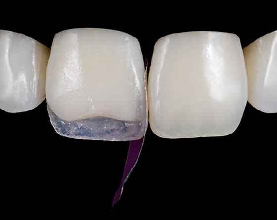 Vertical matrix placement aides in the creation of a mesial interproximal wall