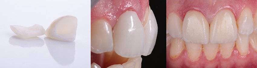 Informative oral care related imagery with a file name of zirconia-crown-composite-850x225-1.png