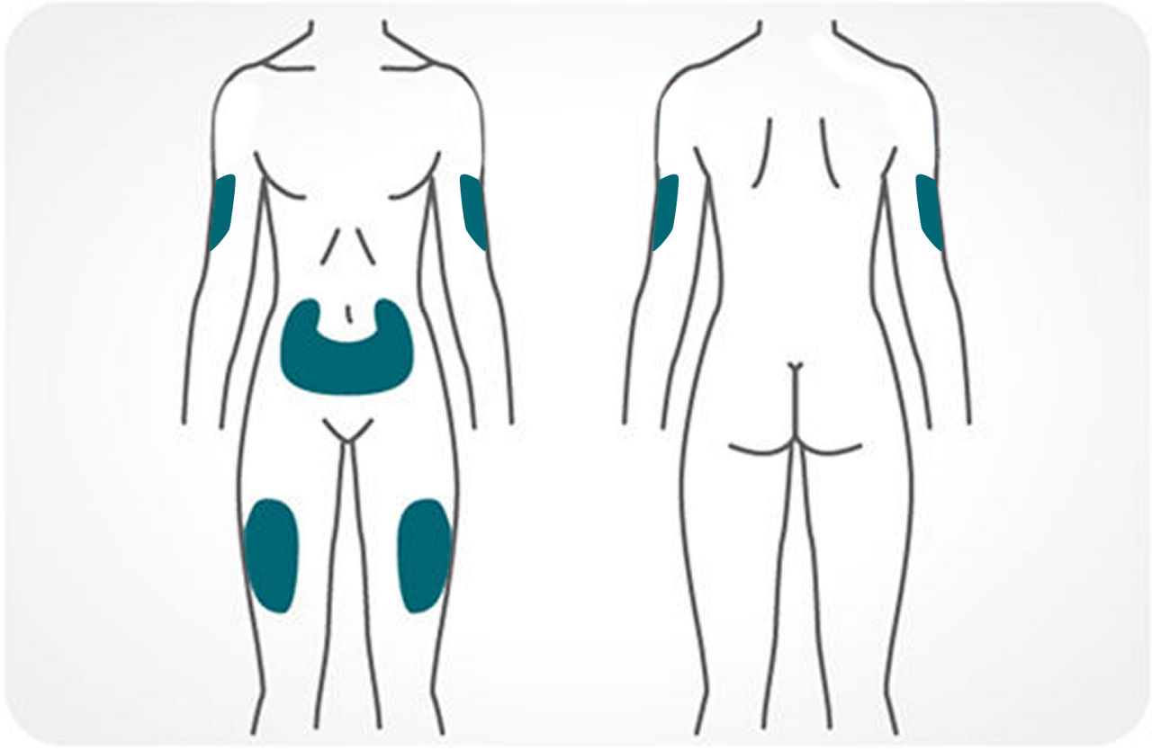 Injection sites labeled on the body