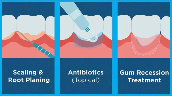 Various kinds of gum treatments including scaling and root planing, antibiotics, and gum recession treatment