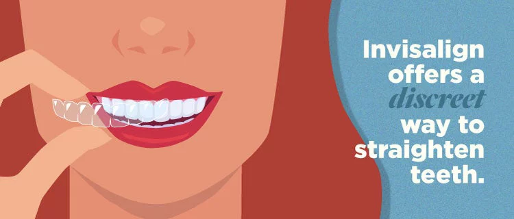 Woman smiling with her clear aligner. Invisalign offers a discreet way to straighten teeth