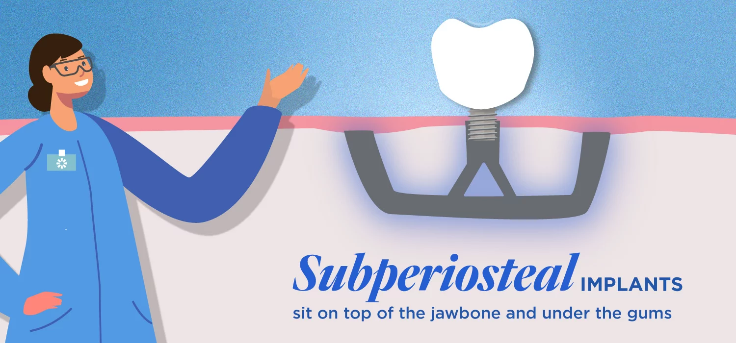 a visual of subperiosteal implants that sit on top of the jawbone and under the gums