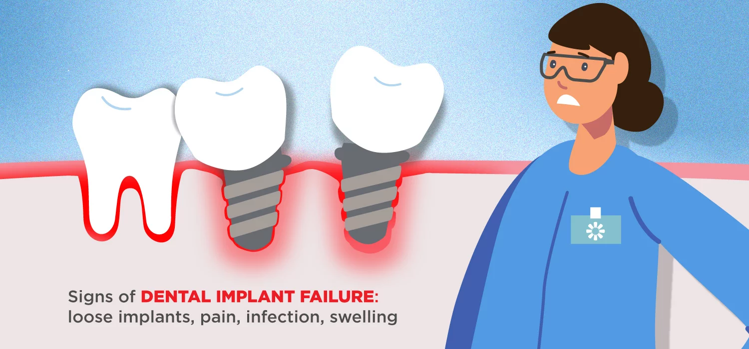 visual on signs of dental implant failures, which consist of loose implants, pain, infection and swelling