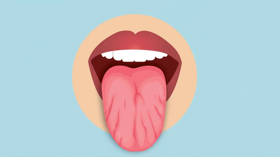 Dry mouth showing a dry tongue