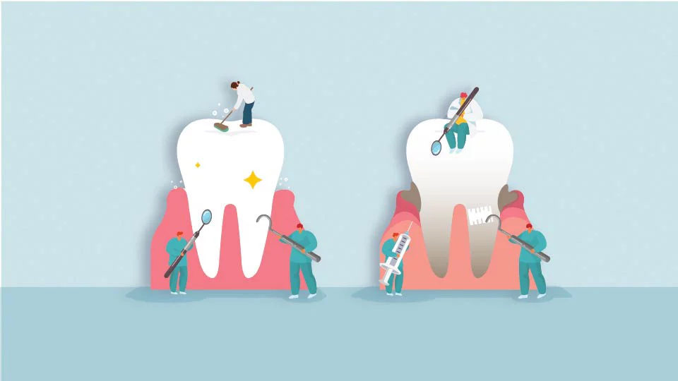 Image of a Deep Cleaning and another tooth getting a regular cleaning