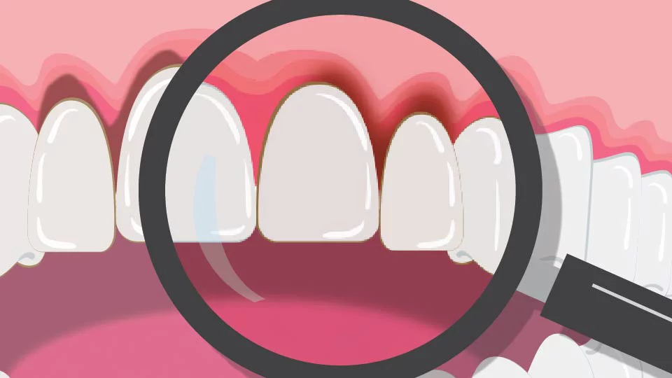 Magnifying glass over tooth that has gum recession and sensitive gums