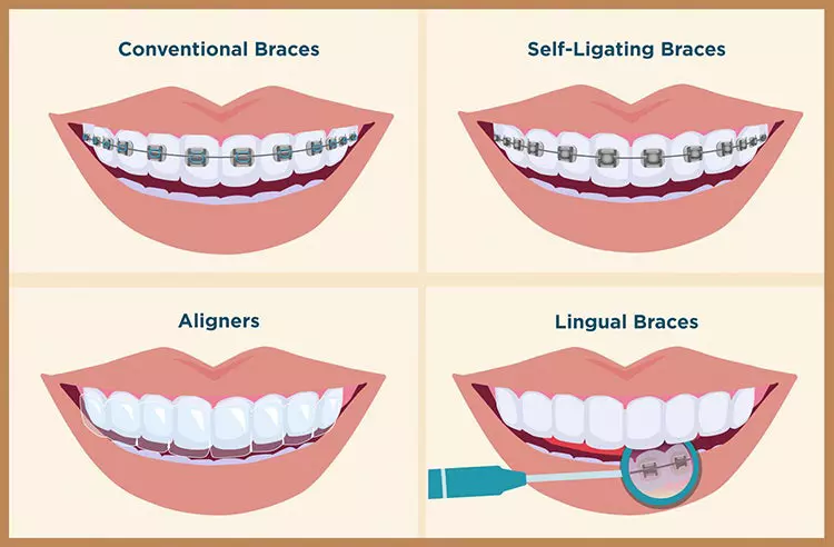 Types of Braces, Connor Orthodontics