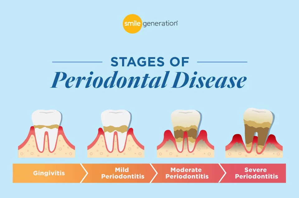 Stages of Periodontal Disease