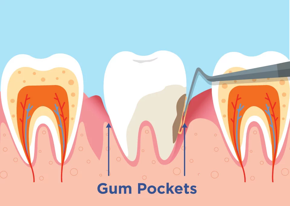 Diagram of gum pockets