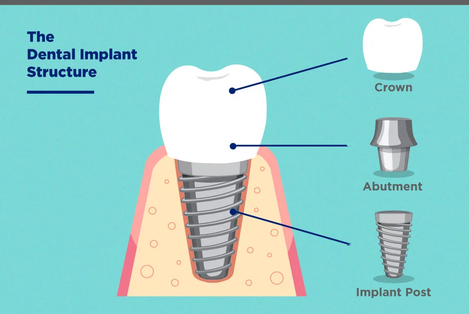 diagram of the structure of a dental implant